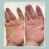 eczema on hands 5 week imrovement