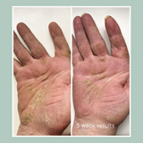 eczema hand cream results