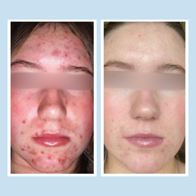 Acne Prone Skin Bundle