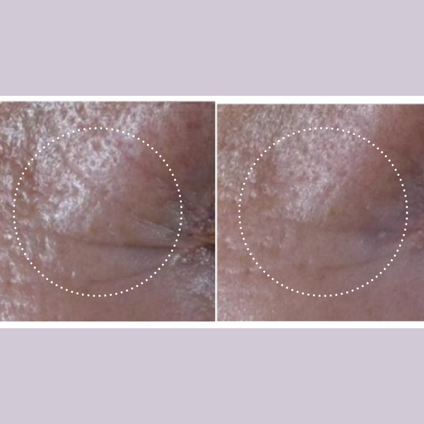 Ultralift Eye Cream for fine lines and wrinkles 15ml