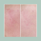 Rosacea Treatment Bundle