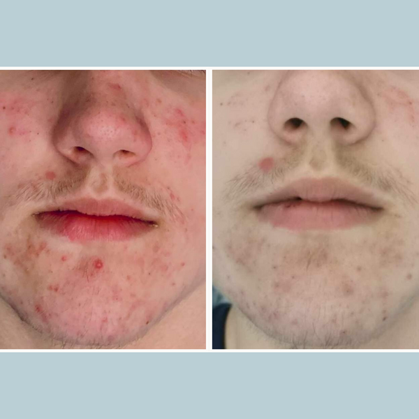 Acne Prone Skin Bundle
