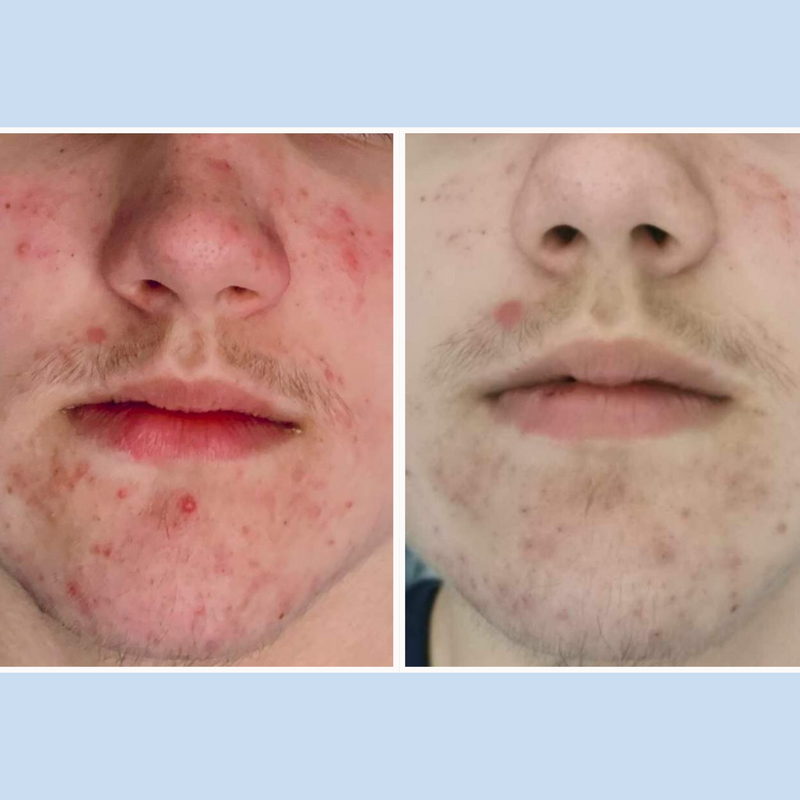 Complete Acne Routine
