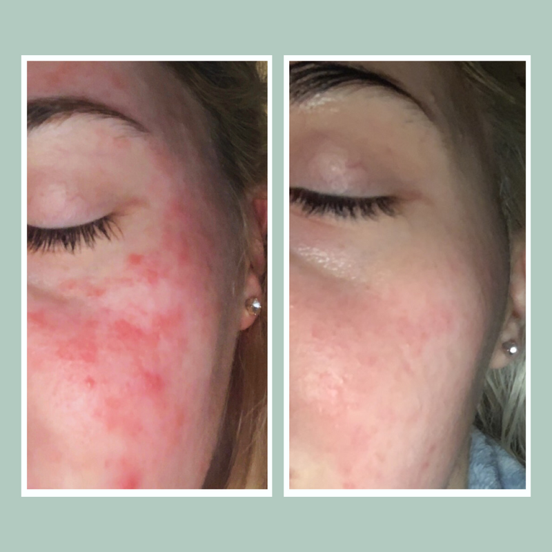 psoriasis topical skincare results